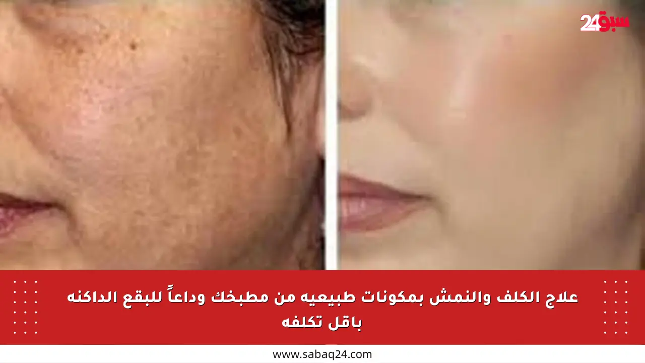 علاج الكلف والنمش بمكونات طبيعية من مطبخك وداعاً للبقع الداكنة بأقل تكلفة